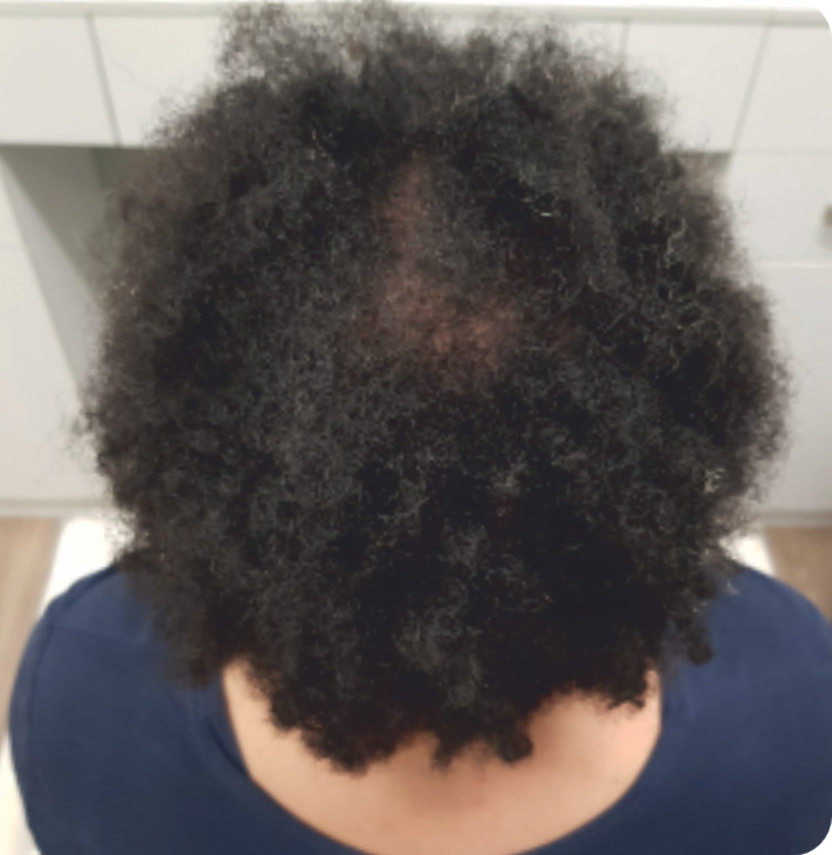 Hair Restoration -  Treatment