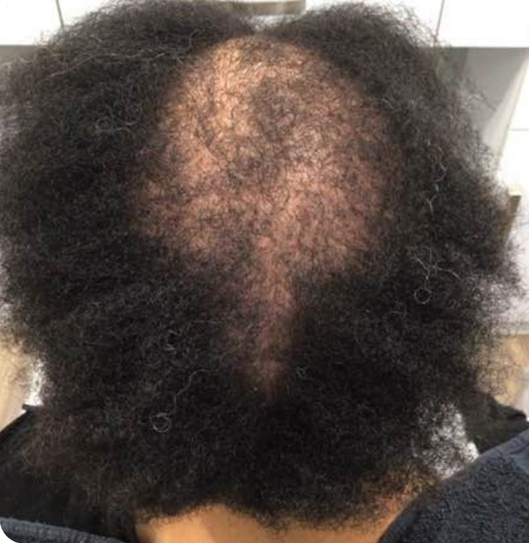 Hair Restoration -  Treatment