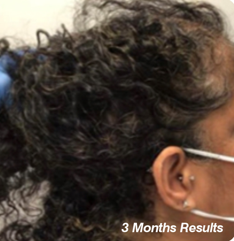 Hair Restoration -  Treatment