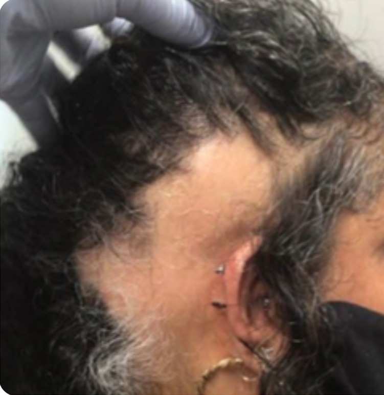 Hair Restoration -  Treatment