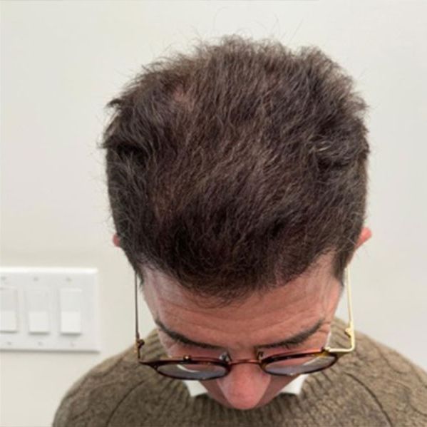 Advanced Hair Transplant Procedure - Dr Brown's Group