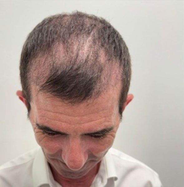 Advanced Hair Transplant Procedure - Dr Brown's Group
