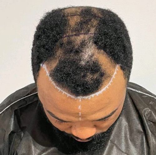 Hair Restoration -  Treatment