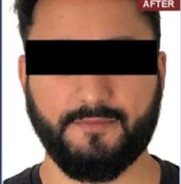 Beard Transplant Procedure - Dr Brown's Group