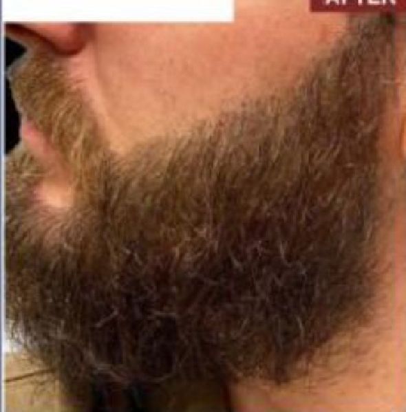 Beard Transplant Procedure - Dr Brown's Group