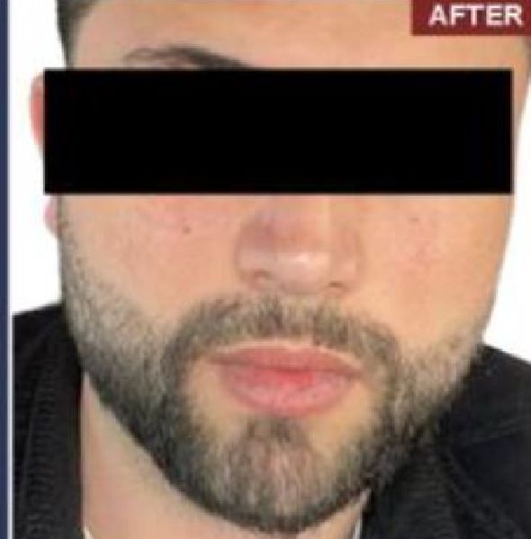 Beard Transplant Procedure - Dr Brown's Group