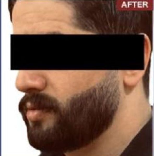 Beard Transplant Procedure - Dr Brown's Group