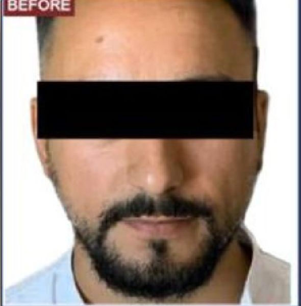 Beard Transplant Procedure - Dr Brown's Group