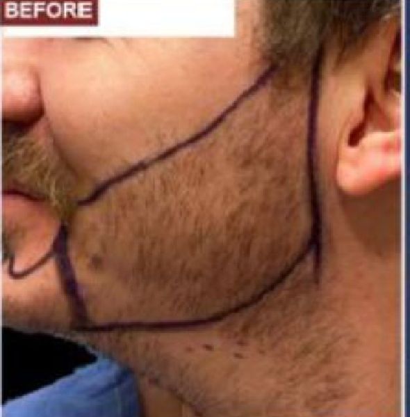 Beard Transplant Procedure - Dr Brown's Group