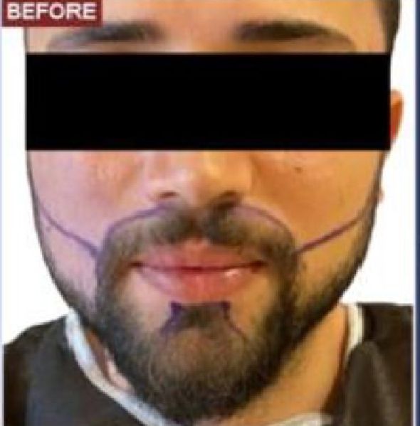 Beard Transplant Procedure - Dr Brown's Group