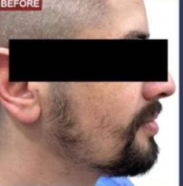 Beard Transplant Procedure - Dr Brown's Group