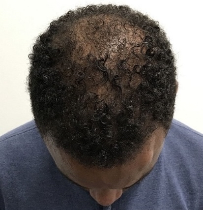 Advanced Hair Transplant Procedure - Dr Brown's Group