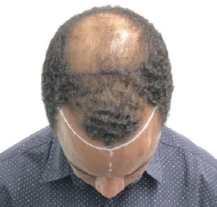 Advanced Hair Transplant Procedure - Dr Brown's Group