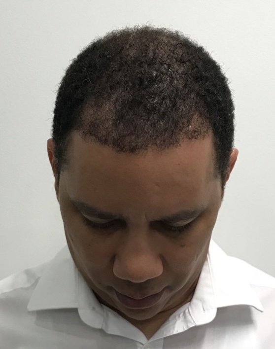 Advanced Hair Transplant Procedure - Dr Brown's Group