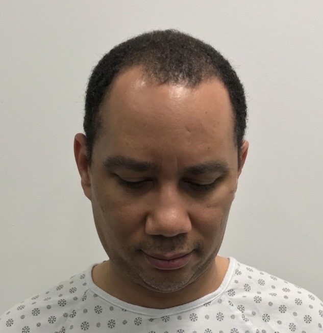 Advanced Hair Transplant Procedure - Dr Brown's Group