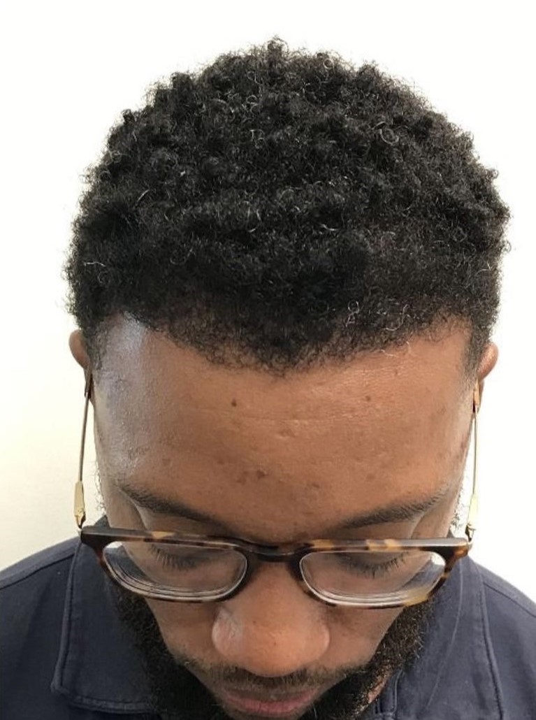 Advanced Hair Transplant Procedure - Dr Brown's Group