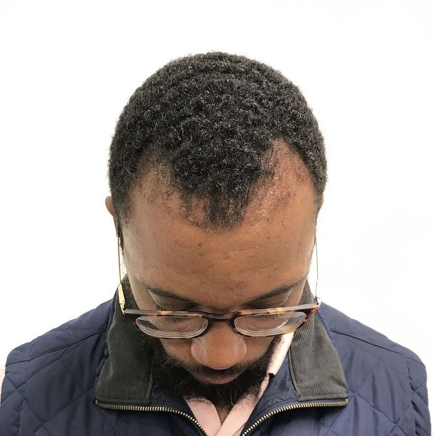 Advanced Hair Transplant Procedure - Dr Brown's Group